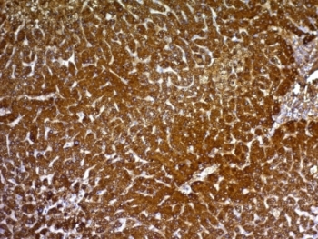 Hepatocyte Specific Antigen Antibody - Formalin-fixed, paraffin-embedded human hepatocellular carcinoma stained with HepPar1 antibody.  This image was taken for the unmodified form of this product. Other forms have not been tested.