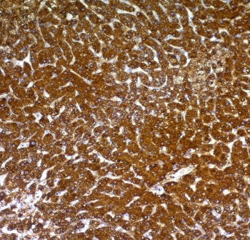 Hepatocyte Specific Antigen Antibody - IHC staining of human hepatocellular carcinoma with Hep Par 1 antibody (clone OCH1E5). Required HIER: boil tissue sections in 1mM EDTA, pH 7.5-8.5, for 10-20 min followed by cooling at RT for 20 min.