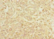 HEPH / Hephaestin Antibody - Immunohistochemistry of paraffin-embedded human pancreatic cancer at dilution 1:100