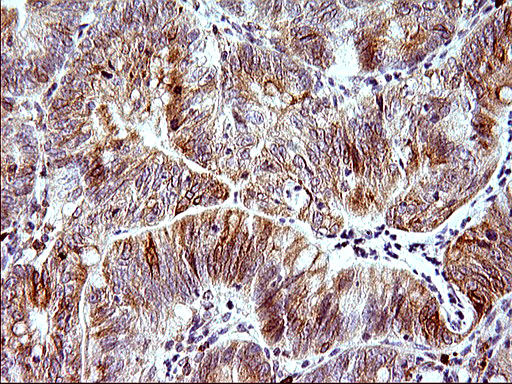 HERPUD1 / HERP Antibody - IHC of paraffin-embedded Carcinoma of Human pancreas tissue using anti-HERPUD1 mouse monoclonal antibody. (Heat-induced epitope retrieval by 1 mM EDTA in 10mM Tris, pH8.5, 120°C for 3min).