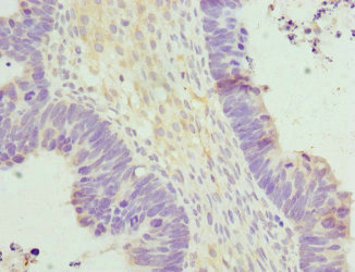 HERPUD1 / HERP Antibody - Immunohistochemistry of paraffin-embedded human ovarian cancer at dilution 1:100