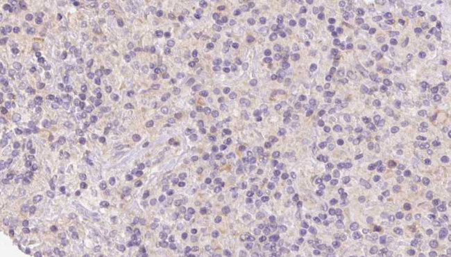 HERPUD1 / HERP Antibody - 1:100 staining human lymph carcinoma tissue by IHC-P. The sample was formaldehyde fixed and a heat mediated antigen retrieval step in citrate buffer was performed. The sample was then blocked and incubated with the antibody for 1.5 hours at 22°C. An HRP conjugated goat anti-rabbit antibody was used as the secondary.