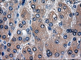 HES1 / HES-1 Antibody - Immunohistochemical staining of paraffin-embedded Carcinoma of liver using anti-HES1 mouse monoclonal antibody.