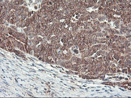 HES1 / HES-1 Antibody - IHC of paraffin-embedded Adenocarcinoma of Human ovary tissue using anti-HES1 mouse monoclonal antibody.