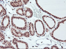 HES1 / HES-1 Antibody - IHC of paraffin-embedded Carcinoma of Human thyroid tissue using anti-HES1 mouse monoclonal antibody.