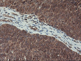 HES1 / HES-1 Antibody - IHC of paraffin-embedded Carcinoma of Human bladder tissue using anti-HES1 mouse monoclonal antibody.