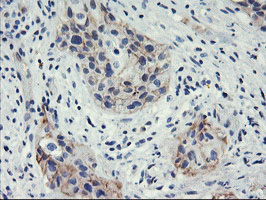 HES1 / HES-1 Antibody - IHC of paraffin-embedded Carcinoma of Human bladder tissue using anti-HES1 mouse monoclonal antibody.