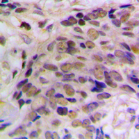 HES6 Antibody - Immunohistochemical analysis of HES6 staining in human prostate cancer formalin fixed paraffin embedded tissue section. The section was pre-treated using heat mediated antigen retrieval with sodium citrate buffer (pH 6.0). The section was then incubated with the antibody at room temperature and detected using an HRP conjugated compact polymer system. DAB was used as the chromogen. The section was then counterstained with hematoxylin and mounted with DPX.