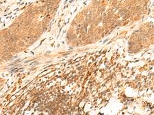 HES7 Antibody - Immunohistochemistry of paraffin-embedded Human esophagus cancer tissue  using HES7 Polyclonal Antibody at dilution of 1:25(×200)