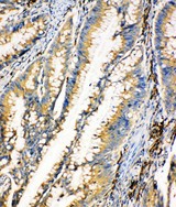 HEXA Antibody - HEXA antibody. IHC(P): Human Intestinal Cancer Tissue.