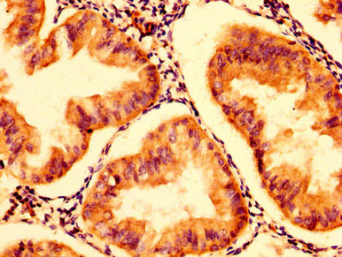 HEXA Antibody - Immunohistochemistry image at a dilution of 1:300 and staining in paraffin-embedded human endometrial cancer performed on a Leica BondTM system. After dewaxing and hydration, antigen retrieval was mediated by high pressure in a citrate buffer (pH 6.0) . Section was blocked with 10% normal goat serum 30min at RT. Then primary antibody (1% BSA) was incubated at 4 °C overnight. The primary is detected by a biotinylated secondary antibody and visualized using an HRP conjugated SP system.