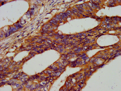 HEXB Antibody - Immunohistochemistry image at a dilution of 1:300 and staining in paraffin-embedded human colon cancer performed on a Leica BondTM system. After dewaxing and hydration, antigen retrieval was mediated by high pressure in a citrate buffer (pH 6.0) . Section was blocked with 10% normal goat serum 30min at RT. Then primary antibody (1% BSA) was incubated at 4 °C overnight. The primary is detected by a biotinylated secondary antibody and visualized using an HRP conjugated SP system.