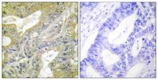 HEXB Antibody - Peptide - + Immunohistochemistry analysis of paraffin-embedded human colon carcinoma tissue using HEXB antibody.
