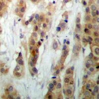 HEXIM1 Antibody - Immunohistochemical analysis of HEXIM1 staining in human breast cancer formalin fixed paraffin embedded tissue section. The section was pre-treated using heat mediated antigen retrieval with sodium citrate buffer (pH 6.0). The section was then incubated with the antibody at room temperature and detected using an HRP conjugated compact polymer system. DAB was used as the chromogen. The section was then counterstained with hematoxylin and mounted with DPX.
