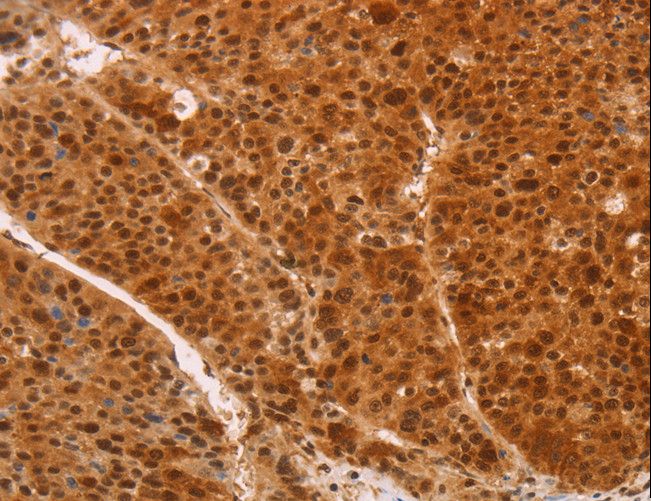 HEXIM1 Antibody - Immunohistochemistry of paraffin-embedded Human thyroid cancer using HEXIM1 Polyclonal Antibody at dilution of 1:65.