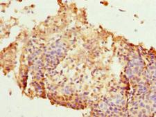 HEXIM1 Antibody - Immunohistochemistry of paraffin-embedded human cervical cancer at dilution 1:100