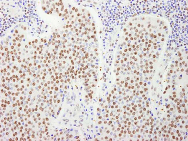 HFip1 / FIP1L1 Antibody - Detection of Human FIP1 by Immunohistochemistry. Sample: FFPE section of human pancreatic islet cell tumor. Antibody: Affinity purified rabbit anti-FIP1 used at a dilution of 1:1000 (1 Detection: DAB.