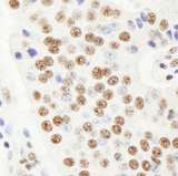 HFip1 / FIP1L1 Antibody - Detection of Human FIP1 by Immunohistochemistry. Sample: FFPE section of human pancreatic islet cell tumor. Antibody: Affinity purified rabbit anti-FIP1 used at a dilution of 1:100.