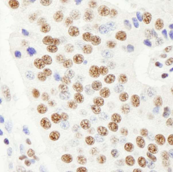 HFip1 / FIP1L1 Antibody - Detection of Human FIP1 by Immunohistochemistry. Sample: FFPE section of human pancreatic islet cell tumor. Antibody: Affinity purified rabbit anti-FIP1 used at a dilution of 1:100.