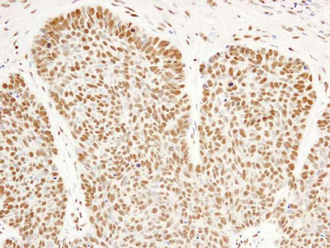 HFip1 / FIP1L1 Antibody - Detection of Human FIP1 by Immunohistochemistry. Sample: FFPE section of human skin cancer. Antibody: Affinity purified rabbit anti-FIP1 used at a dilution of 1:100.