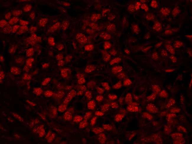 HFip1 / FIP1L1 Antibody - Detection of Human FIP1 by Immunofluorescence. Sample: FFPE section of human breast carcinoma. Antibody: Affinity purified rabbit anti-FIP1 used at a dilution of 1:100. Detection: Red-fluorescent goat anti-rabbit IgG highly cross-adsorbed Antibody used at a dilution of 1:100.