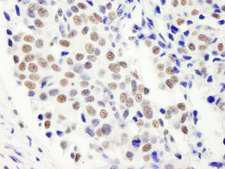HFip1 / FIP1L1 Antibody - Detection of Human FIP1 by Immunohistochemistry. Sample: FFPE section of human breast carcinoma. Antibody: Affinity purified rabbit anti-FIP1 used at a dilution of 1:5000 (0.2 Detection: DAB.