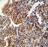 HFM1 Antibody - HFM1 antibody immunohistochemistry of formalin-fixed and paraffin-embedded human lung carcinoma followed by peroxidase-conjugated secondary antibody and DAB staining.