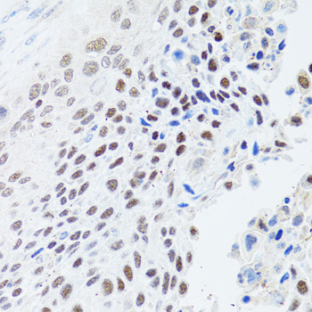 HFM1 Antibody - Immunohistochemistry of paraffin-embedded human lung cancer tissue.