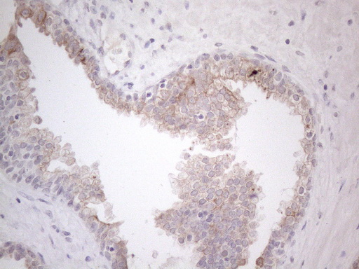 HGF / Hepatocyte Growth Factor Antibody - Immunohistochemical staining of paraffin-embedded Carcinoma of Human prostate tissue using anti-HGF mouse monoclonal antibody. (Heat-induced epitope retrieval by 1mM EDTA in 10mM Tris buffer. (pH8.5) at 120°C for 3 min. (1:150)
