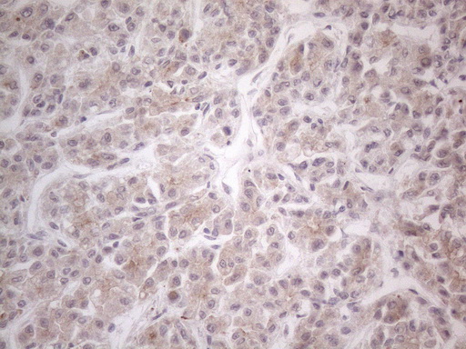 HGF / Hepatocyte Growth Factor Antibody - Immunohistochemical staining of paraffin-embedded Human liver tissue within the normal limits using anti-HGF mouse monoclonal antibody. (Heat-induced epitope retrieval by 1mM EDTA in 10mM Tris buffer. (pH8.5) at 120°C for 3 min. (1:150)