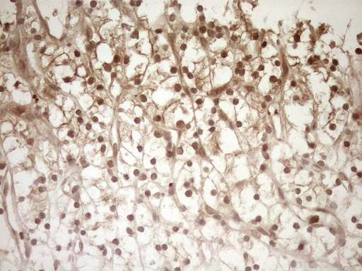 HGF / Hepatocyte Growth Factor Antibody - Immunohistochemical staining of paraffin-embedded Carcinoma of Human kidney tissue using anti-HGF mouse monoclonal antibody. (Heat-induced epitope retrieval by 1mM EDTA in 10mM Tris buffer. (pH8.5) at 120°C for 3 min. (1:150)
