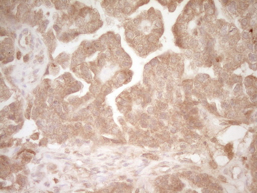 HGF / Hepatocyte Growth Factor Antibody - Immunohistochemical staining of paraffin-embedded Adenocarcinoma of Human ovary tissue using anti-HGF mouse monoclonal antibody. (Heat-induced epitope retrieval by 1 mM EDTA in 10mM Tris, pH8.5, 120C for 3min,
