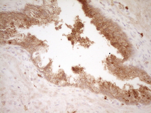 HGF / Hepatocyte Growth Factor Antibody - Immunohistochemical staining of paraffin-embedded Adenocarcinoma of Human endometrium tissue using anti-HGF mouse monoclonal antibody. (Heat-induced epitope retrieval by 1 mM EDTA in 10mM Tris, pH8.5, 120C for 3min,