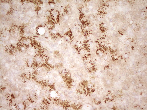 HGF / Hepatocyte Growth Factor Antibody - Immunohistochemical staining of paraffin-embedded Human liver tissue within the normal limits using anti-HGF mouse monoclonal antibody. (Heat-induced epitope retrieval by 1 mM EDTA in 10mM Tris, pH8.5, 120C for 3min,