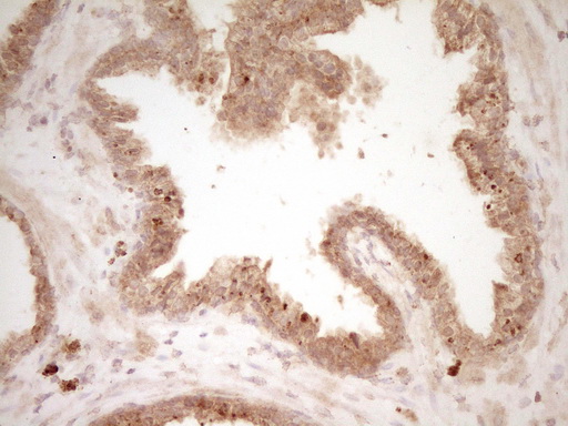 HGF / Hepatocyte Growth Factor Antibody - Immunohistochemical staining of paraffin-embedded Carcinoma of Human prostate tissue using anti-HGF mouse monoclonal antibody. (Heat-induced epitope retrieval by 1 mM EDTA in 10mM Tris, pH8.5, 120C for 3min,