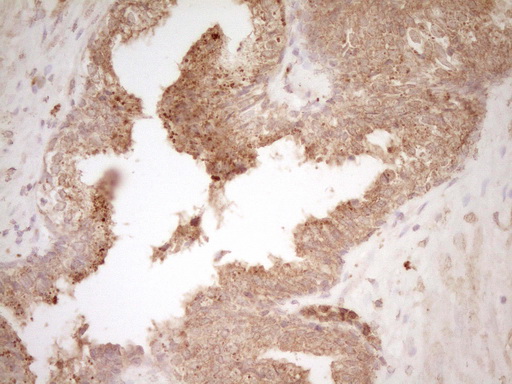 HGF / Hepatocyte Growth Factor Antibody - IHC of paraffin-embedded Adenocarcinoma of Human endometrium tissue using anti-HGF mouse monoclonal antibody. (Heat-induced epitope retrieval by 1 mM EDTA in 10mM Tris, pH8.5, 120°C for 3min).