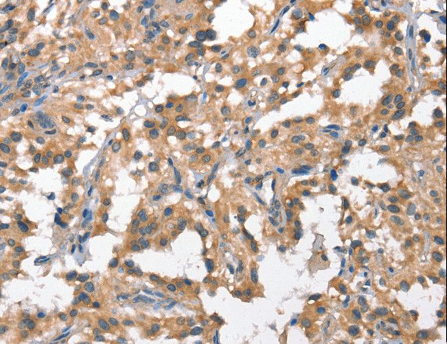HGF / Hepatocyte Growth Factor Antibody - Immunohistochemistry of paraffin-embedded Human breast cancer using HGF Polyclonal Antibody at dilution of 1:65.