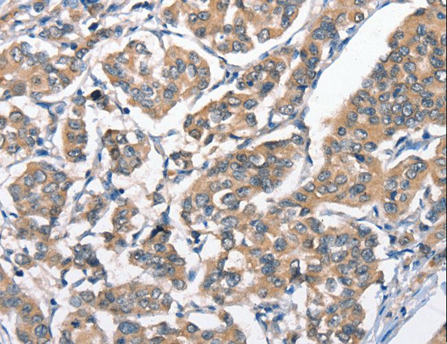 HGF / Hepatocyte Growth Factor Antibody - Immunohistochemistry of paraffin-embedded Human breast cancer using HGF Polyclonal Antibody at dilution of 1:65.