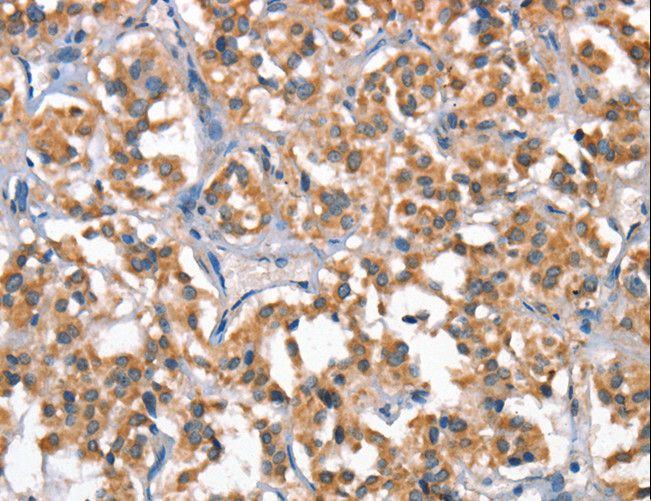 HGF / Hepatocyte Growth Factor Antibody - Immunohistochemistry of paraffin-embedded Human gastric cancer using HGF Polyclonal Antibody at dilution of 1:65.