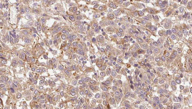 HGFAC / HGFA Antibody - 1:100 staining human Melanoma tissue by IHC-P. The sample was formaldehyde fixed and a heat mediated antigen retrieval step in citrate buffer was performed. The sample was then blocked and incubated with the antibody for 1.5 hours at 22°C. An HRP conjugated goat anti-rabbit antibody was used as the secondary.