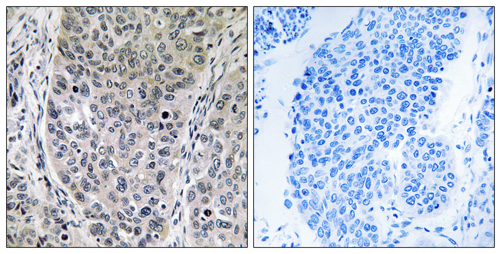 HGH1 / FAM203A Antibody - Immunohistochemistry analysis of paraffin-embedded human lung carcinoma tissue, using BRP16 Antibody. The picture on the right is blocked with the synthesized peptide.