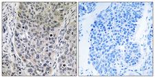 HGH1 / FAM203A Antibody - Immunohistochemistry analysis of paraffin-embedded human lung carcinoma tissue, using BRP16 Antibody. The picture on the right is blocked with the synthesized peptide.