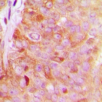 HGH1 / FAM203A Antibody - Immunohistochemical analysis of FAM203A staining in human breast cancer formalin fixed paraffin embedded tissue section. The section was pre-treated using heat mediated antigen retrieval with sodium citrate buffer (pH 6.0). The section was then incubated with the antibody at room temperature and detected with HRP and DAB as chromogen. The section was then counterstained with hematoxylin and mounted with DPX.