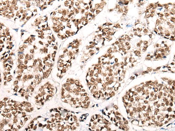 HGH1 / FAM203A Antibody - Immunohistochemistry of paraffin-embedded Human esophagus cancer tissue  using HGH1 Polyclonal Antibody at dilution of 1:45(×200)
