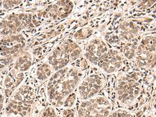 HGH1 / FAM203A Antibody - Immunohistochemistry of paraffin-embedded Human esophagus cancer tissue  using HGH1 Polyclonal Antibody at dilution of 1:45(×200)