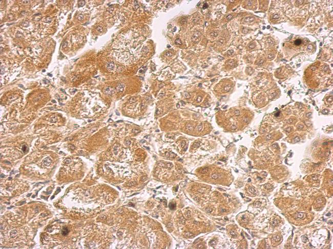 HHIP / HIP Antibody - HHIP antibody [N3C2], Internal detects HHIP protein at cytosol on hepatoma by immunohistochemical analysis. Sample: Paraffin-embedded hepatoma. HHIP antibody [N3C2], Internal dilution:1:500.