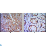 HHIP / HIP Antibody - Immunohistochemistry (IHC) analysis of paraffin-embedded human lung cancer (A), colon cancer (B) with DAB staining using Hip Monoclonal Antibody.