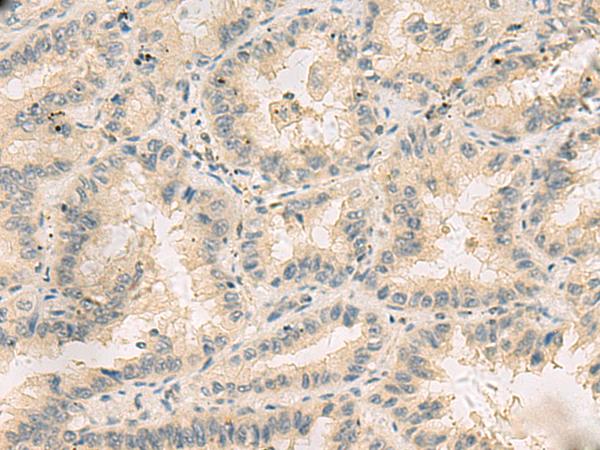 HHIPL2 Antibody - Immunohistochemistry of paraffin-embedded Human lung cancer tissue  using HHIPL2 Polyclonal Antibody at dilution of 1:55(×200)