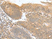 HHIPL2 Antibody - Immunohistochemistry of paraffin-embedded Human colorectal cancer tissue  using HHIPL2 Polyclonal Antibody at dilution of 1:50(×200)