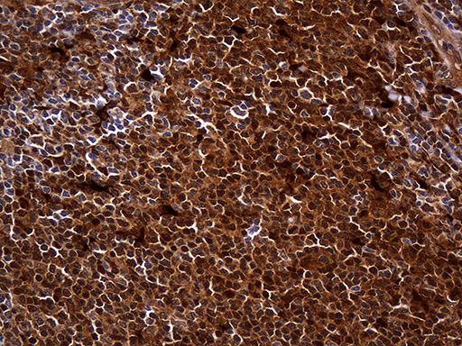 HHLA3 Antibody - Immunohistochemical staining of paraffin-embedded Human lymphoma tissue using anti-HHLA3 mouse monoclonal antibody. (Heat-induced epitope retrieval by 1mM EDTA in 10mM Tris buffer. (pH8.5) at 120°C for 3 min. (1:500)